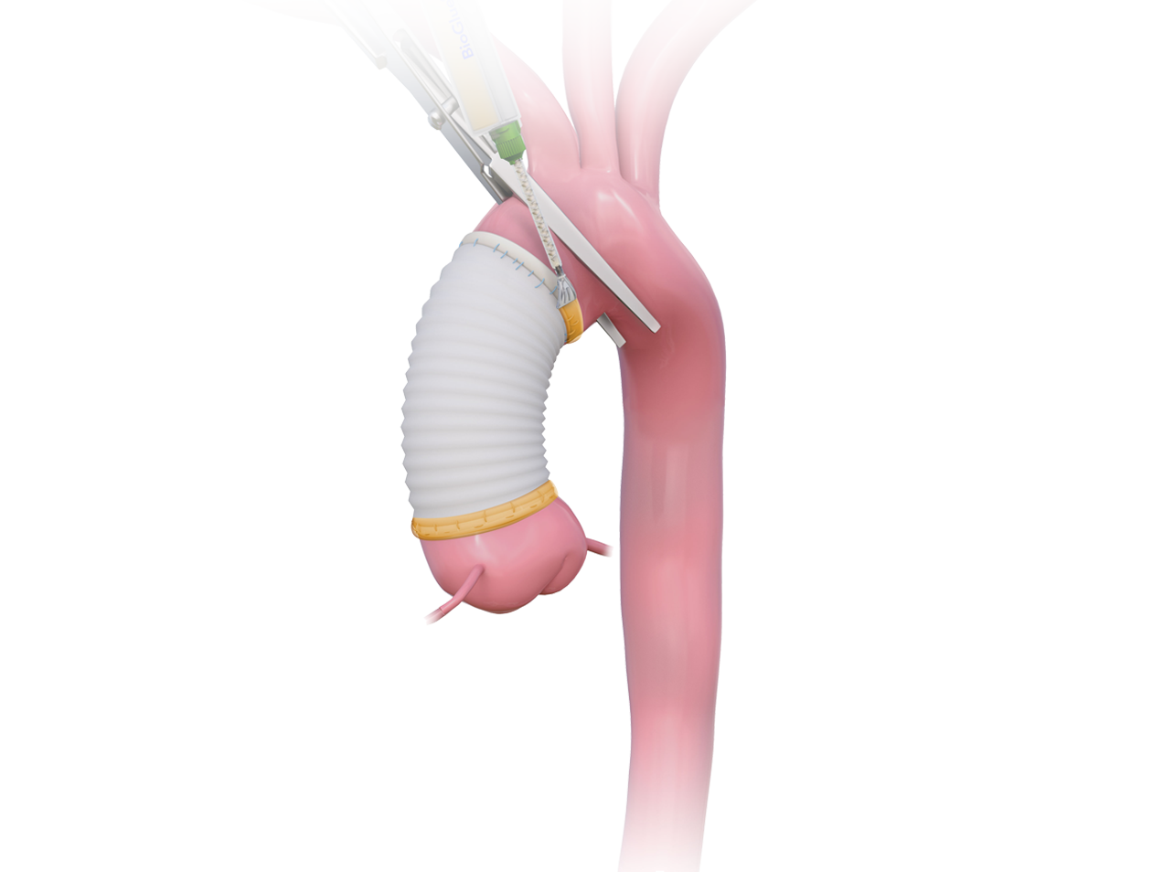 BioGlue Aorta