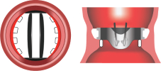 Incomplete Annulus Support (2)
