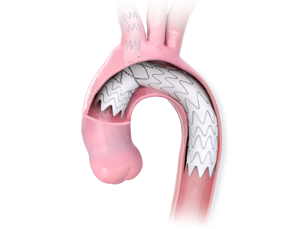 Nexus in Aorta