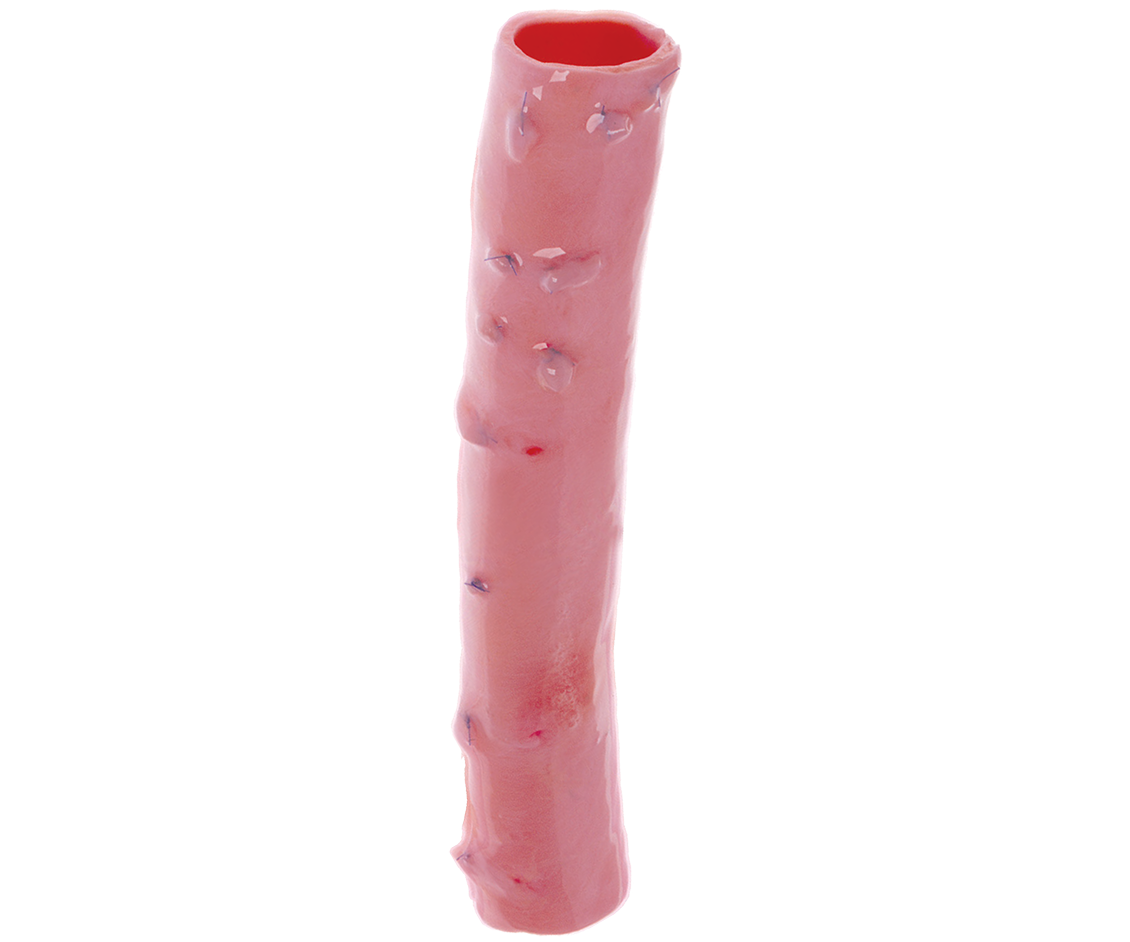 US-CryoGraft-DTA-Hero-1130x942