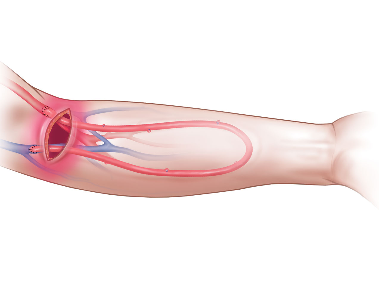US-CryoVein-Femoral-2-(1)