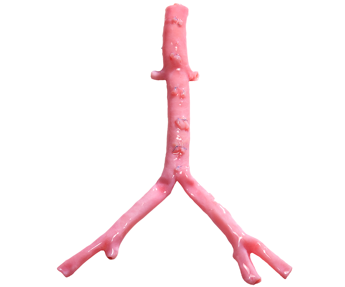 US_Aorta_Iiacc-Hero-1130x942