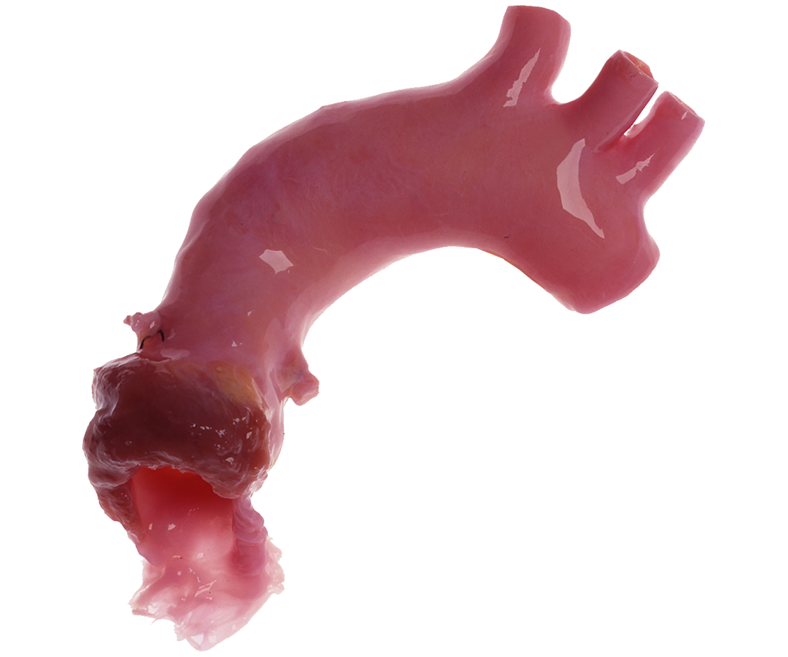 US_CryoValve_Aortic-Hero-1130x942