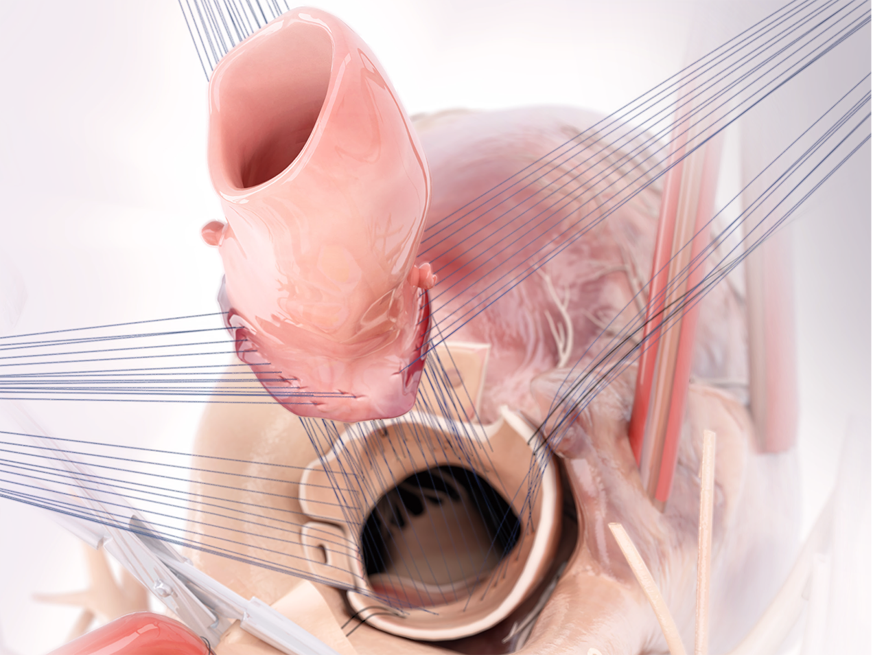 US_CryoValve_Aortic-Product-Highlights-1272x954