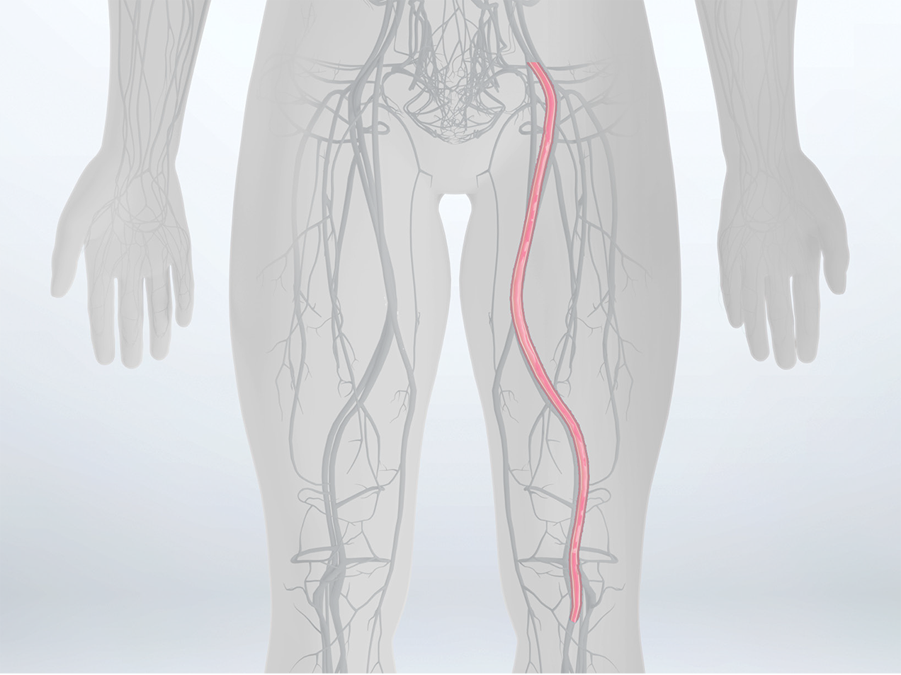 US_Fermoral_Artery-Product-Hightlights-1272x954