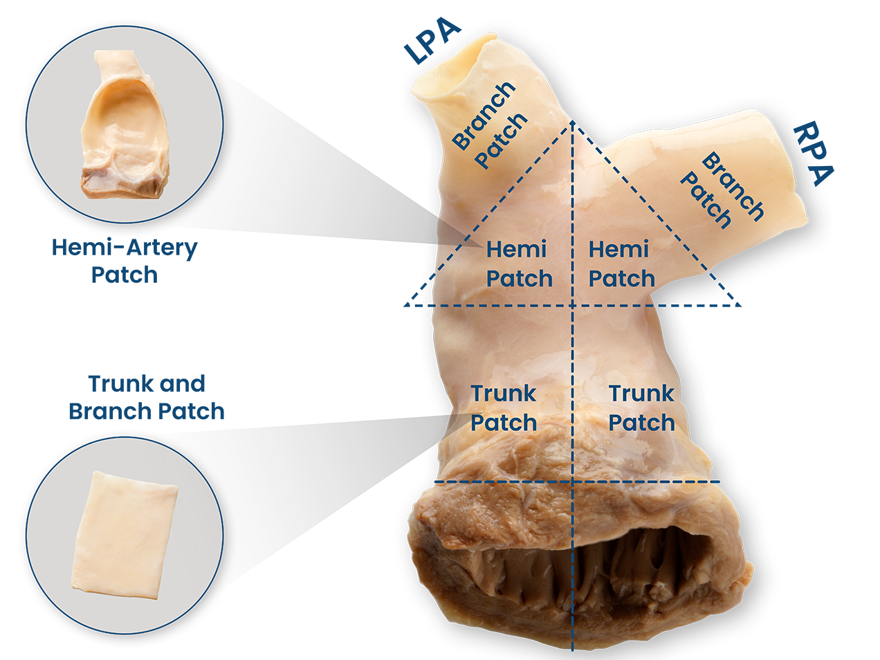 US_SG_Pulmonary_Patch-Produc-Highlights-1272x954