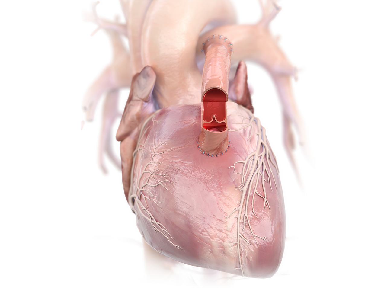 US-Cryovein-PC-Produc-Highlights-1272x954png