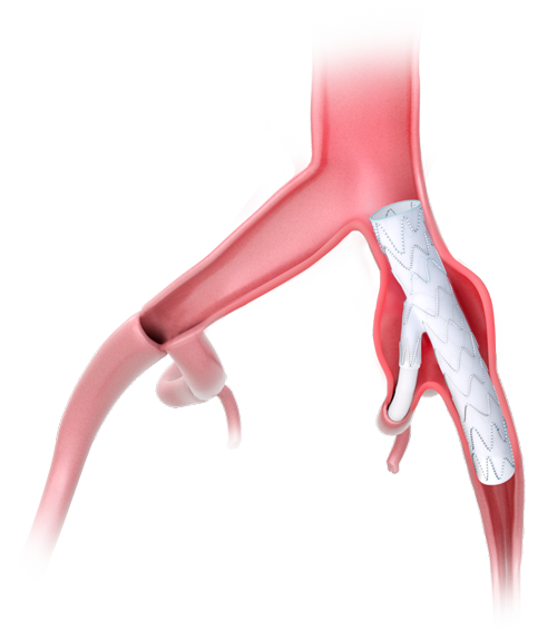 products-in-aorta_E-liac_RGB