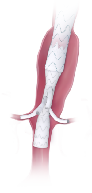 products-in-aorta_E-nside_RGB