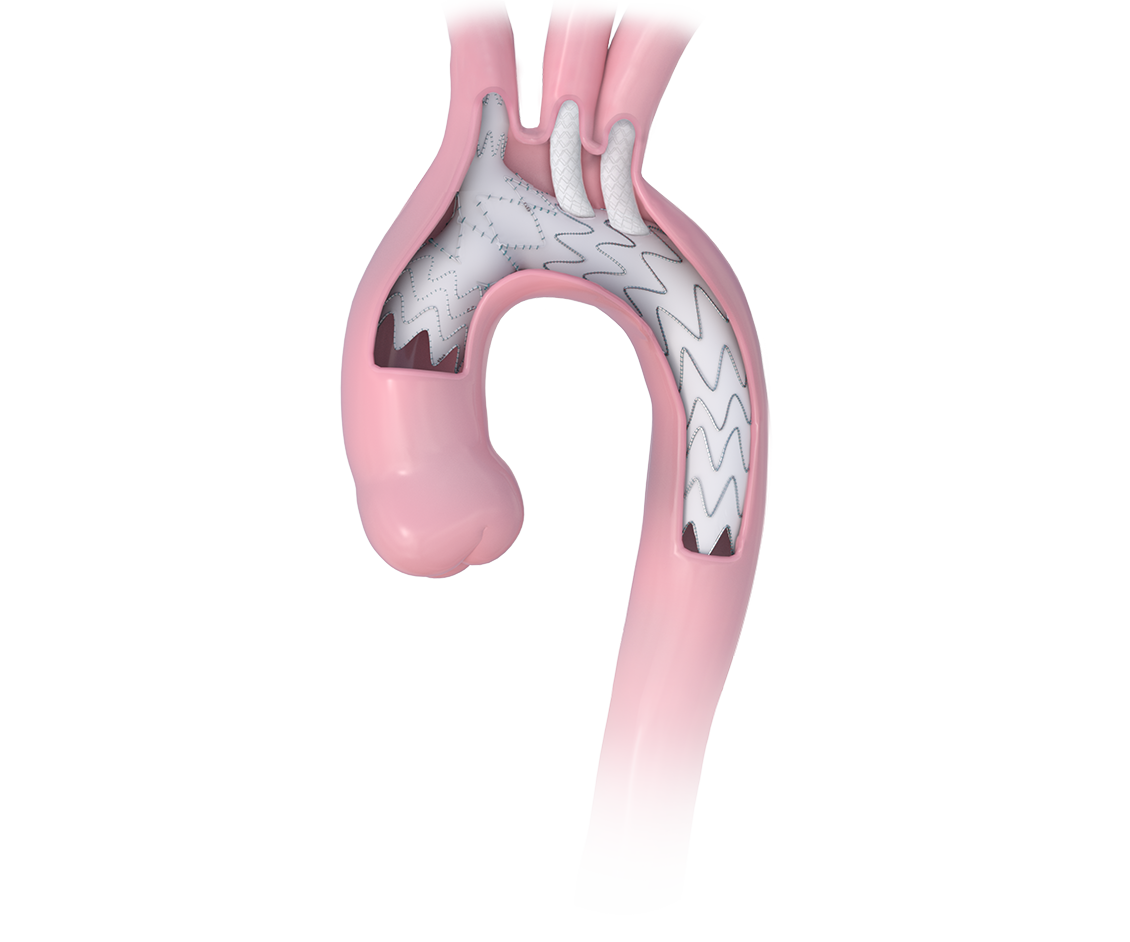 products-in-aorta_NEXUS-TRE_RGB